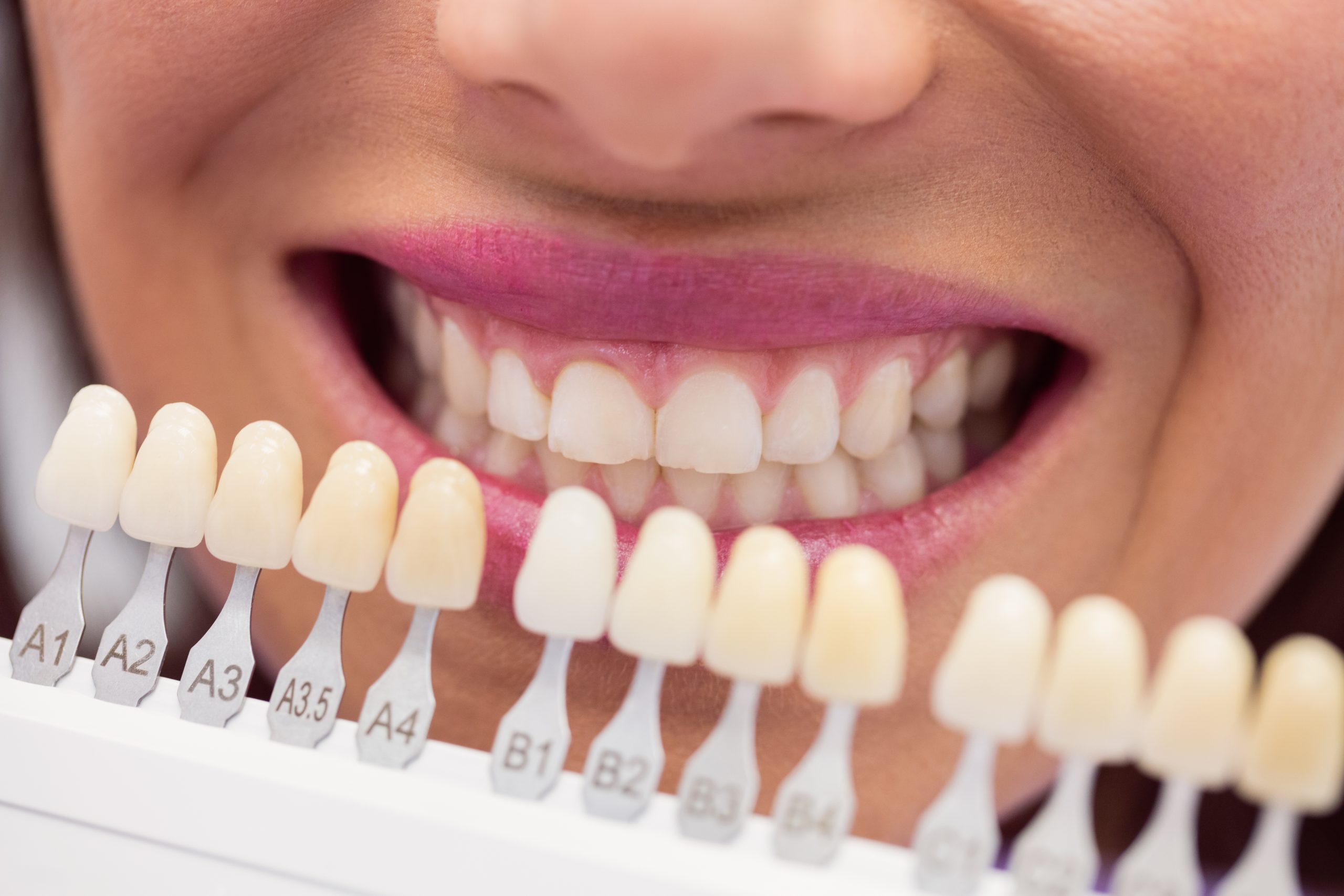 Are Veneers Fake-Looking? And Other Common Misconceptions About Dental Veneers Debunked